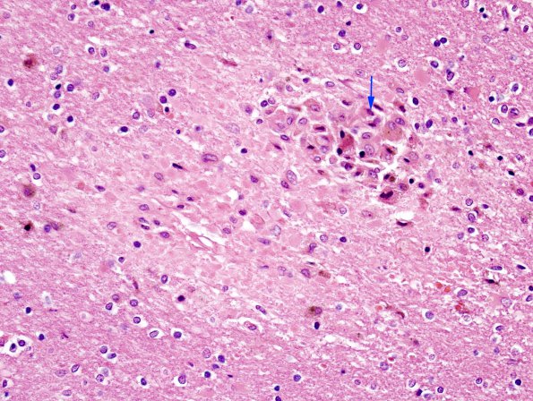 2B3 Fat Embolism (Case 2) H&E 5 copy