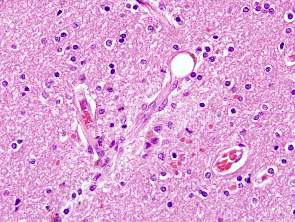 2B4 Fat Embolism (Case 2) H&E 19