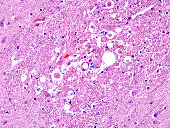 2B5 Embolism, fat (Case 2) H&E 27 copy copy