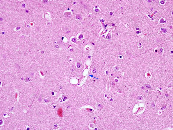 2B6 Fat Embolism (Case 2) H&E 9 copy