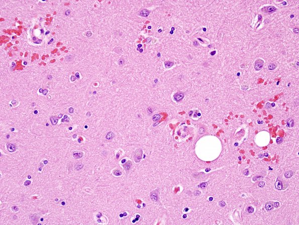 2B8 Fat Embolism (Case 2) H&E 20