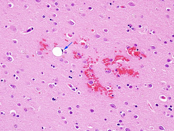 2B9 Fat Embolism (Case 2) H&E 25 copy