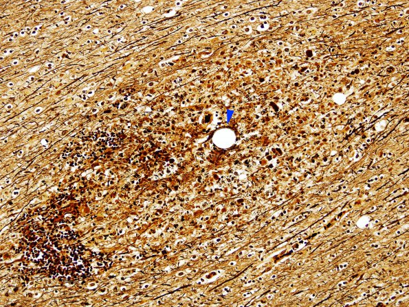 2C1 Fat Embolism (Case 2) 14A Biels copy