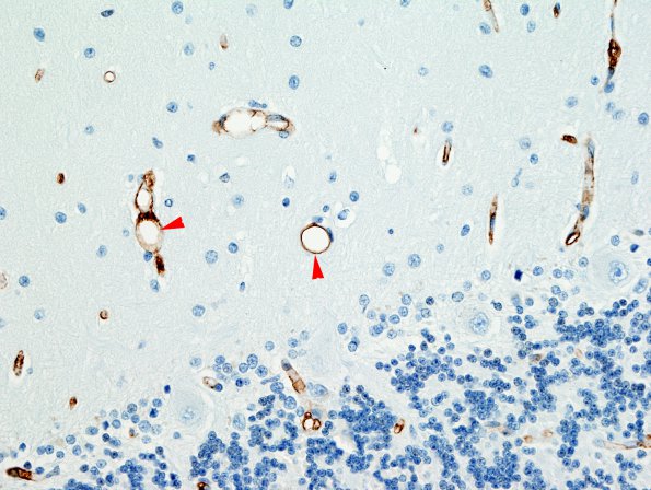 2D1 Fat Embolism (Case 2) CD34 5 copy