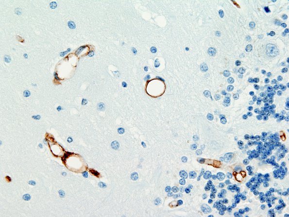 2D2 Fat Embolism (Case 2) CD34 6