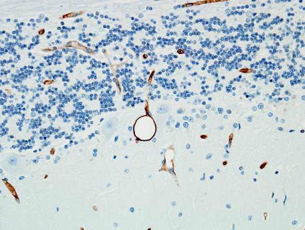 2D3 Fat Embolism (Case 2) CD34 7