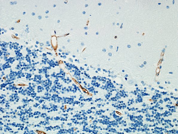 2D4 Fat Embolism (Case 2) CD34 9