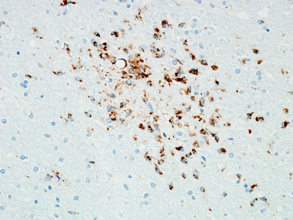 2E1 Fat Embolism (Case 2) CD68 6