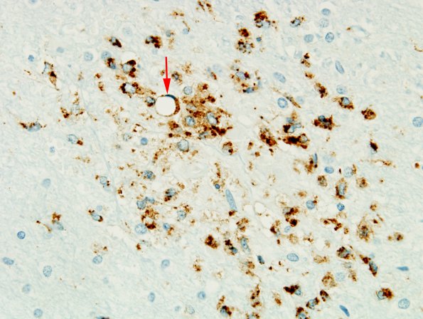 2E2 Fat Embolism (Case 2) CD68 2 copy