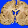 3A1 Embolism, Fat (Case 3) 4 (2)