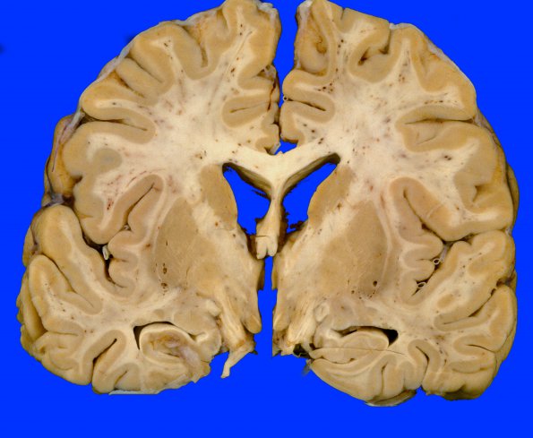 3A1 Embolism, Fat (Case 3) 4 (2)