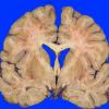 3A3 Embolism, fat (Case 3) 6