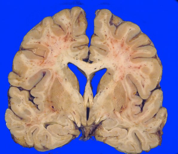 3A3 Embolism, fat (Case 3) 6