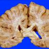 3A4 Embolism, Fat (Case 3) 7