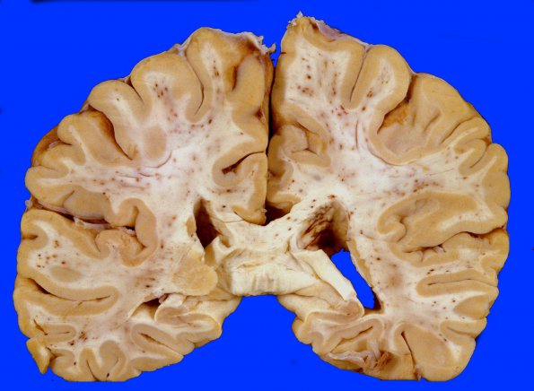 3A4 Embolism, Fat (Case 3) 7