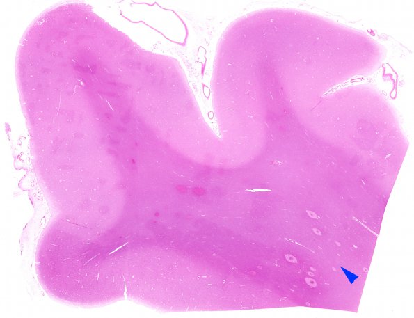 3B1 Fat Embolism (Case 3) H&E whole mount match with A copy