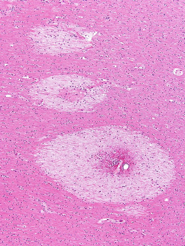 3B2 Fat Embolism (Case 3) H&E 10X with A