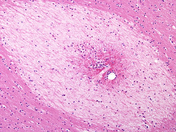 3B3 Embolism, Fat (Case 3) H&E 9