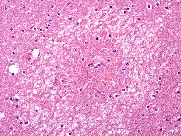 3B5 Embolism, Fat (Case 3) H&E 6