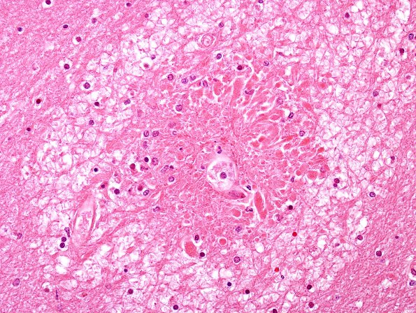 3B6 Embolism, Fat (Case 3) H&E 5