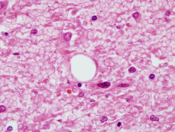 3B7 Embolism, Fat (Case 3) H&E 4