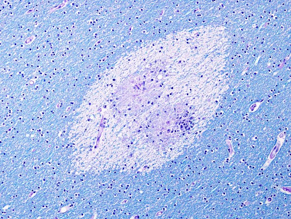 3C1 Embolism, Fat (Case 3) 1 LFB-PAS