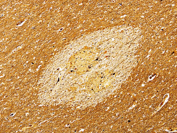 3C2 Embolism, Fat (Case 3) Biels 1