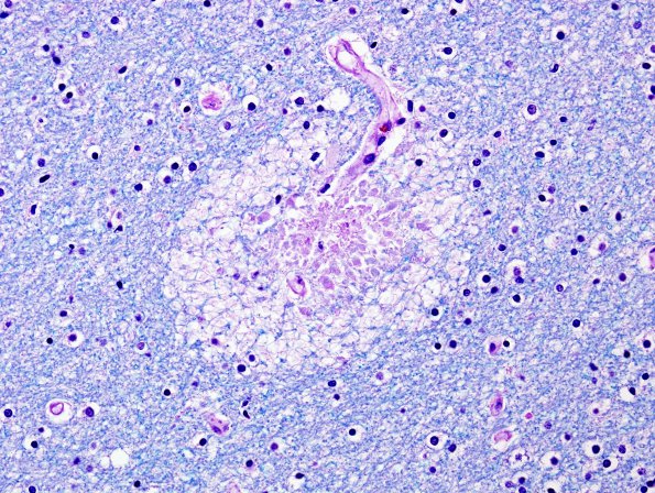 3C3 Embolism, fat (Case 3) LFB-PAS 20X  1