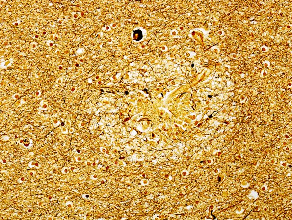 3C4 Fat Embolism (Case 3) Biels 40X  1