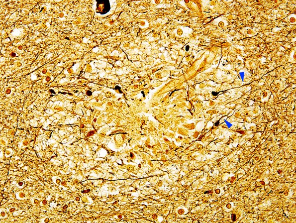 3C5 Embolism, fat (Case 3) Biels 60X  1 copy