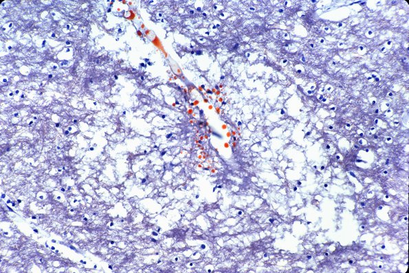 3D Embolism, fat (Case 3) 17