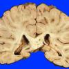 4A1 Embolism, Fat (Case 4) 3