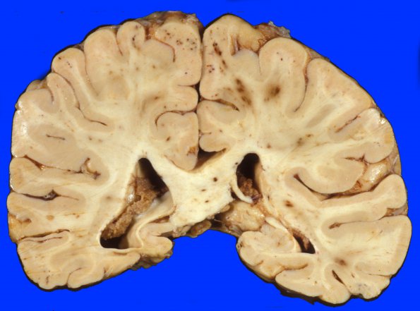 4A1 Embolism, Fat (Case 4) 3