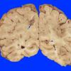 4A4 Embolism, Fat (Case 4) 4 copy