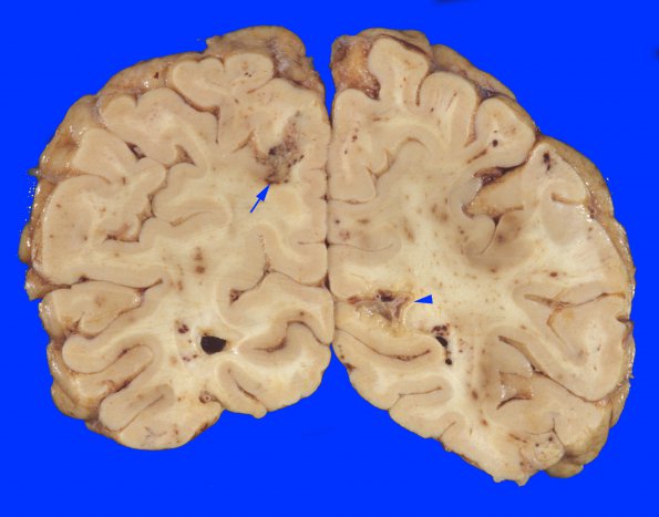 4A4 Embolism, Fat (Case 4) 4 copy