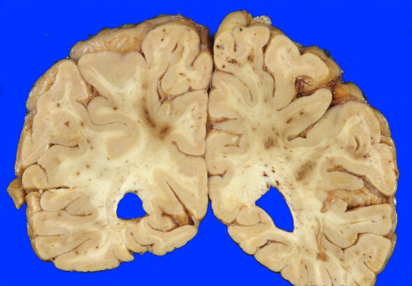 4A6 Embolism, Fat (Case 4) 6