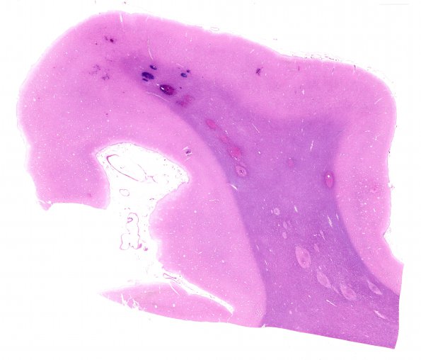 4B1 Embolism, fat (Case 4) N12 H&E WM