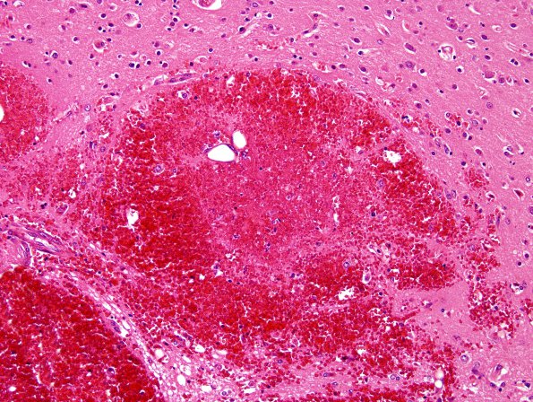 4B2 Fat embolism (Case 4) H&E 7