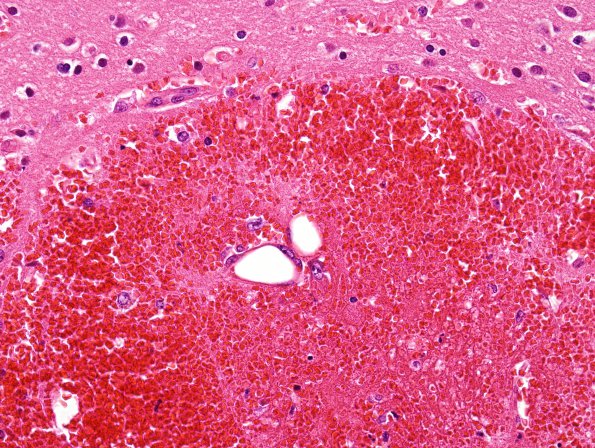 4B3 Fat embolism (Case 4) H&E 4
