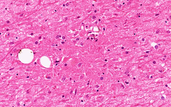 4B4 Embolism, fat (Case 4) N12 H&E 40X