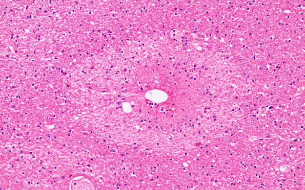 4C3 Embolism, fat (Case 4) N13 H&E 20X