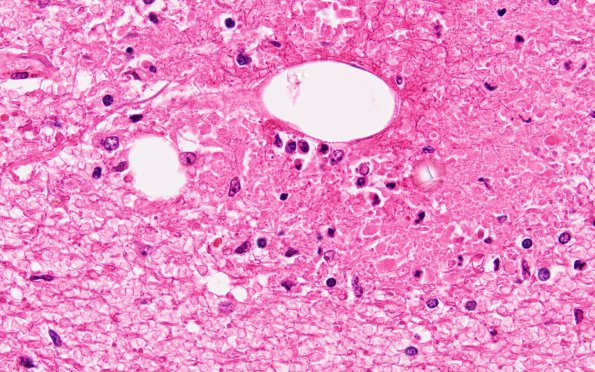 4C4 Embolism, fat (Case 4) N13 H&E 60X