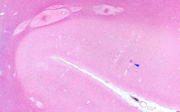 4D3 Fat embolism (Case 4) H&E 2X copy