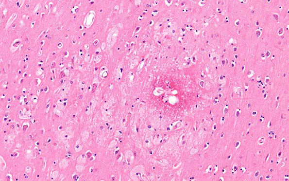 4D4 Fat embolism (Case 4) H&E 20X 1