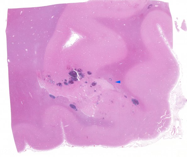 4E1 Fat embolism (Case 4) H&E whole mount copy