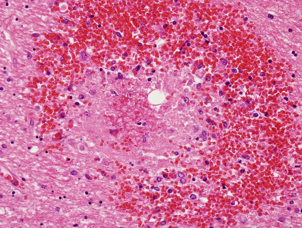 4E3 Fat embolism (Case 4) H&E 8