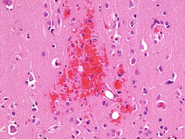 4E4 Fat embolism (Case 4) H&E 3