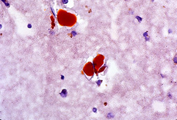 4F2 Embolism, fat (Case 4) ORO 1
