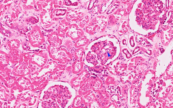 4G1 Embolism, fat (Case 4) Kidney H&E copy