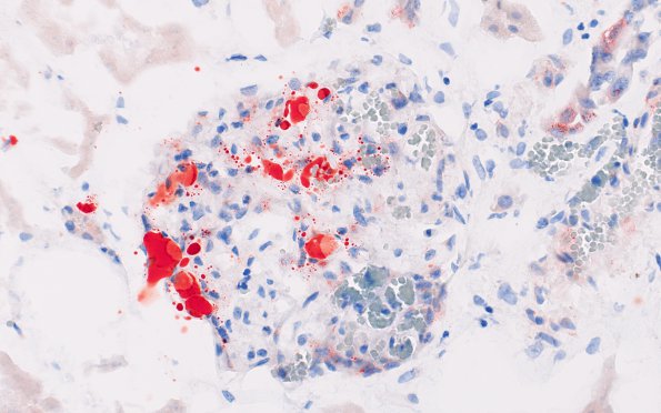 4G2 Embolism, fat (Case 4) Kidney ORO 2